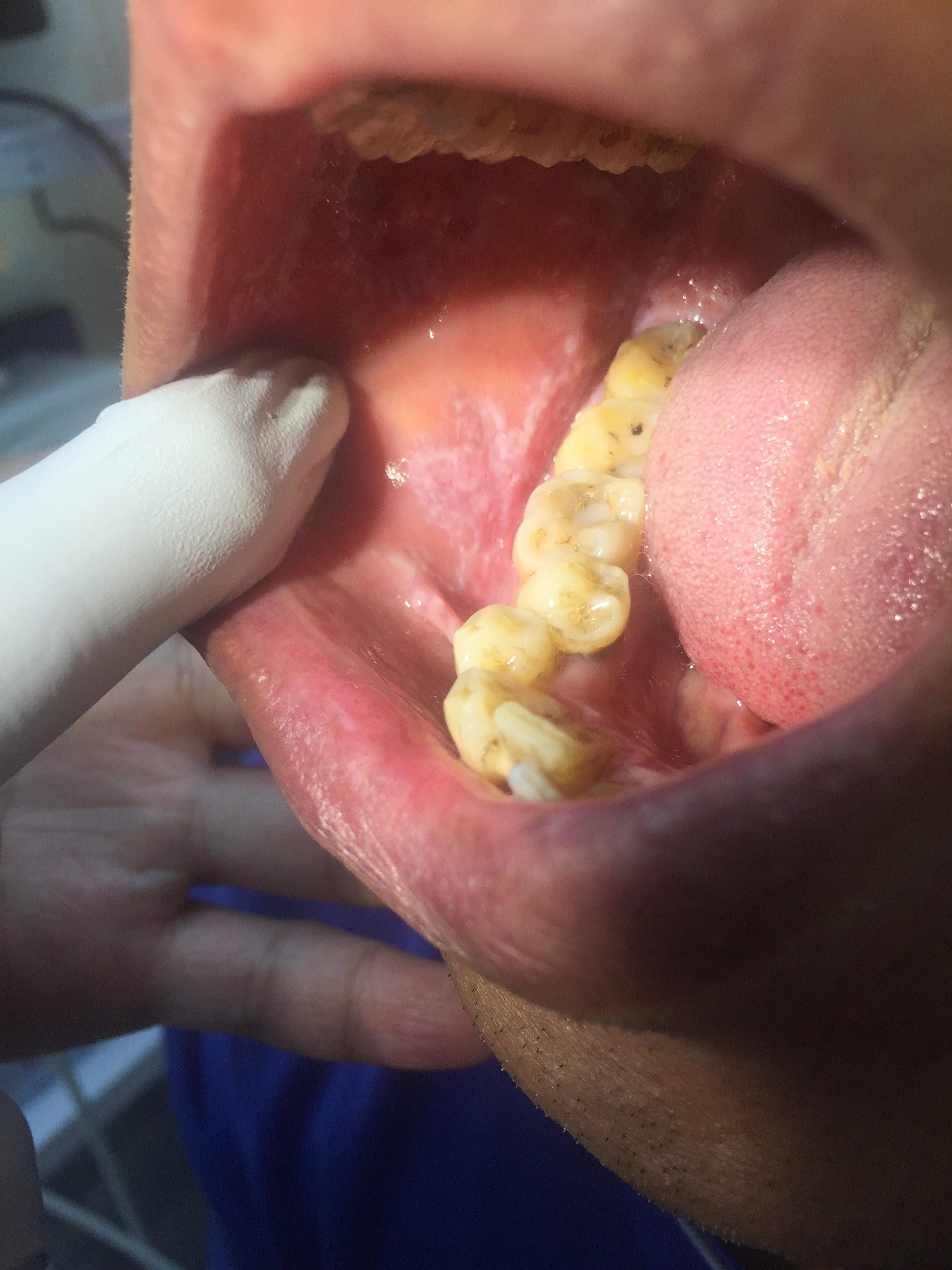 癬 扁平 苔 口腔有白斑 可能罹患扁平苔癬